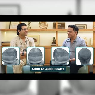 Ankit’s 5-Month Hair Transplant Result ✨

Approximately 4,000–4,500 grafts were transplanted across 