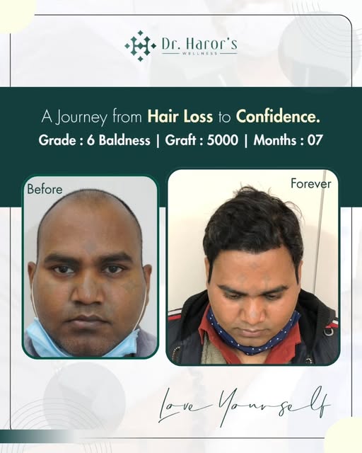 A journey from hair loss to renewed confidence. ✨

Grade 6 hair loss | 5000 grafts | 7-month result
