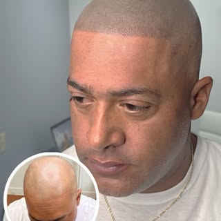 Another satisfied client, scalp micropigmentation same day results guaranteed ❗️Book with confidence