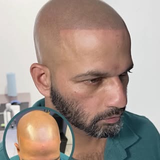 Touch ip for this amazing client, looking brand new scalp micropigmentation same day results guarant
