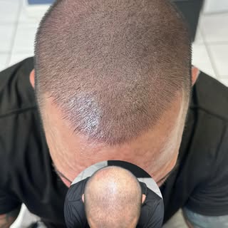 HAIRLINEINK USA - First session adding density👆🏼 same day results guaranteed. Call to schedule you