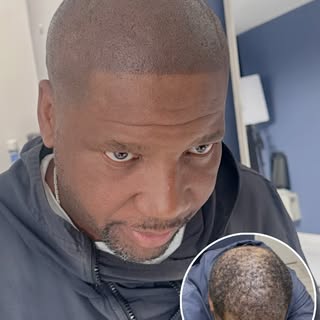 HAIRLINEINK USA - Client wanted add density to make it look fuller, after he went to a different pro