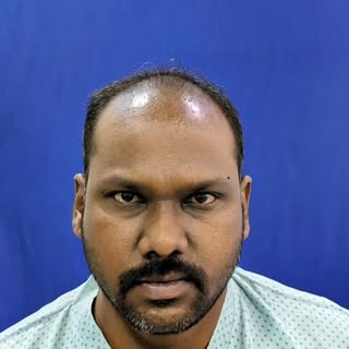 4234 Grafts | Scalp + Beard Transformation 🔥

When precision meets experience — results speak for t