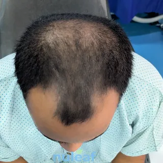 Why choose one when the best results often come from combining treatments?

Hair loss is usually a p