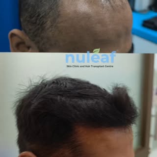 A natural-looking hairline is the foundation of a great hair transplant. The goal isn't just to rest