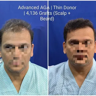 Some cases test everything you know about hair restoration.
Diffuse androgenetic alopecia. Thin dono