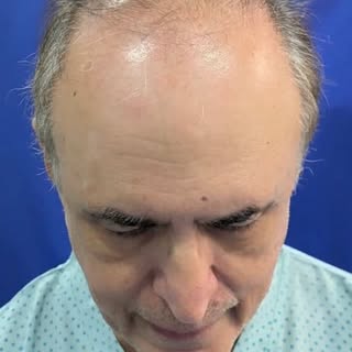 Can a natural hair transplant be achieved at 76 years of age?

This gentleman presented with advance