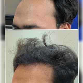 2,750-Graft Hair Transplant Result | One Surgeon, Every Step | Nuleaf Pune

A natural-looking hair t