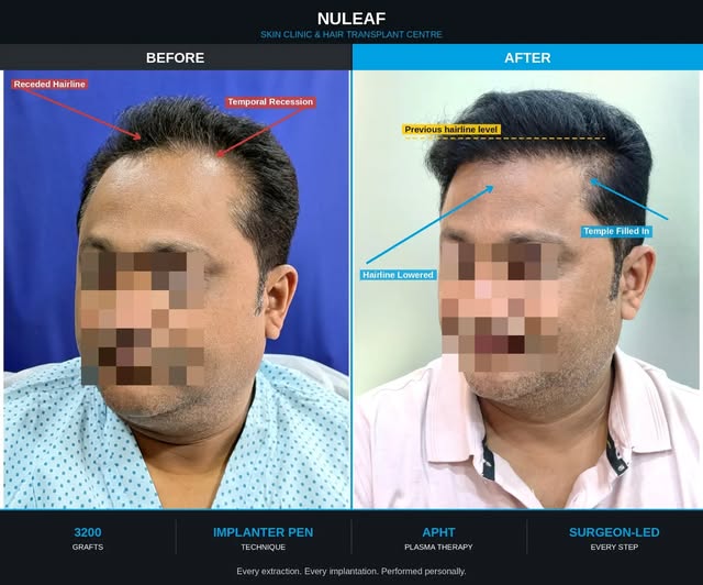 A hair transplant is not just about adding hair — it can change the way someone sees themselves ever