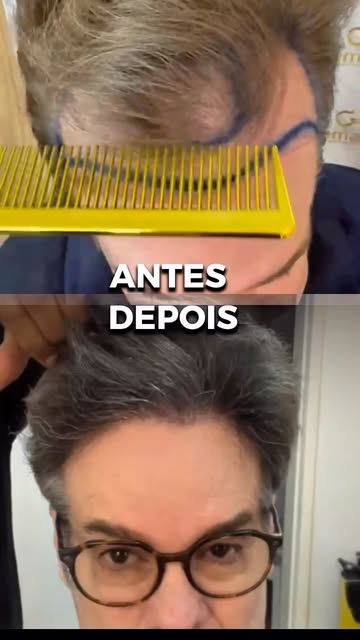 Quando o resultado fala por si, o sorriso confirma. ✨

O antes e depois incrível do @fernandogilgil 