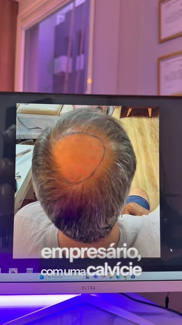Evolução real de transplante capilar: de calvície avançada a resultado natural em 12 meses

Um resul