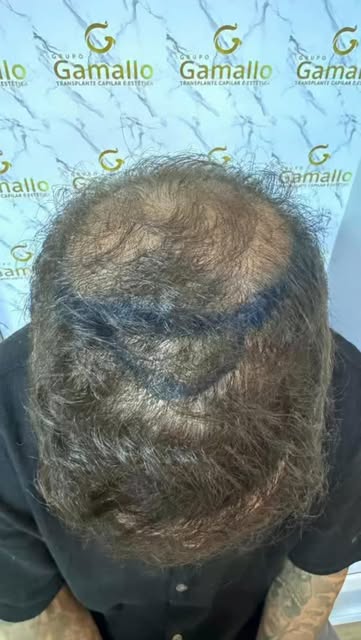 O transplante capilar te humilha antes de te exaltar né?! 

6 meses de transplante e já dá pra ver q