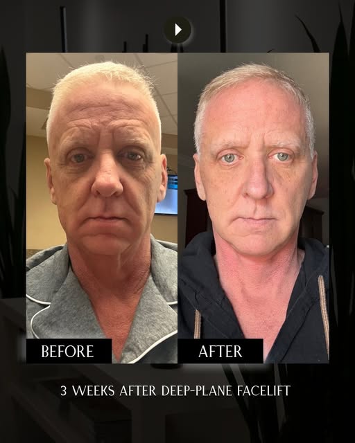 We love patient selfies 🤳 Deep-Plane Facelift + Deep Parotid Fascia Contouring

Just 3 weeks post-o