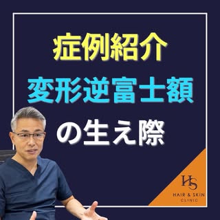 【変形逆富士額の植毛症例のご紹介】

生え際の薄毛のパターンは大きくいくつかに分類されますが、
今回は、逆富士額になっているような
珍しいケースの植毛症例をご紹介します。

YouTubeではより詳し