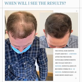When will I see the results of my hair transplant?

Patience is one of the most important parts of t
