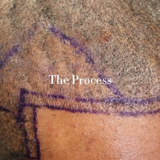 At GK Hair Restoration, we are committed to delivering the best possible hair restoration results fo