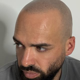 **Micropigmentación Capilar en 2 Sesiones** 

En nuestro tratamiento de micropigmentación capilar, r