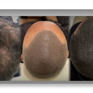 ✨ Micropigmentación capilar efecto densidad tras un injerto capilar ✨

📸 Foto 1 – Antes:
El cabello