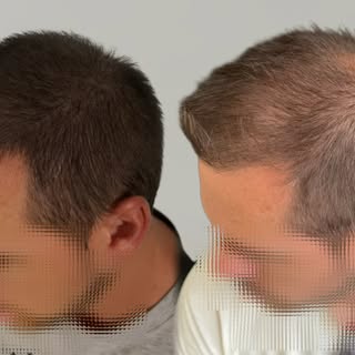 ✨ ANTES & DESPUÉS | MICROPIGMENTACIÓN CAPILAR ✨

Un resultado natural no se consigue de un día para 