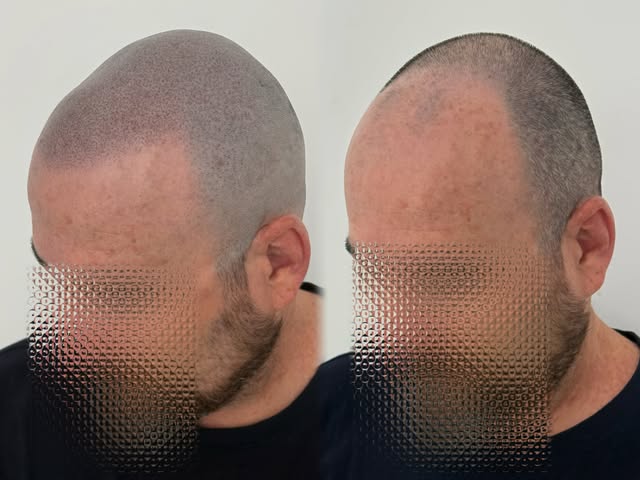 PRIMERA SESIÓN ✨ | MICROPIGMENTACIÓN CAPILAR

Nuestro método está diseñado en 2 sesiones, porque par