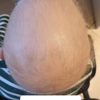 Łysienia u dzieci obserwowane są z coraz większą częstotliwością. Te o charakterze plackowatym potra