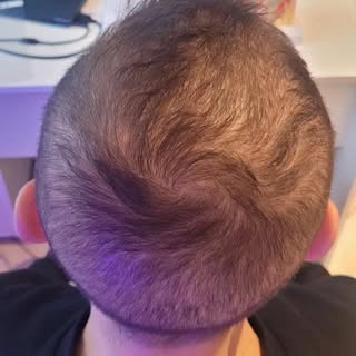 A dziś dla odmiany męska głowa i jakże przyjemna dla oka trychologa kontrola.... 4 miesiące kuracji 