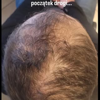 Efekty terapii łysień androgenowych to nigdy "przed" i "po", a jedynie "przed" i "w trakcie", bo wal