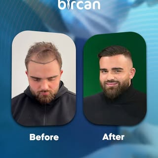 Accurate analysis, personalized planning, and a successful result. Witness our patient’s hair transp