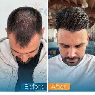 1-year transformation of a 5000-graft hair transplant procedure, designed in alignment with natural 