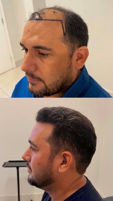 6 meses de diferença! 

Ver um paciente voltar a sorrir e recuperar a confiança não tem preço. O tra
