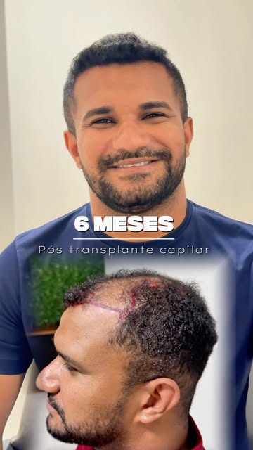 Seis meses de evolução e uma história que merece ser compartilhada.

O Edson chegou com um quadro de