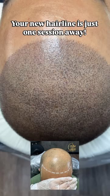 Thinking about changing your look? 🤔 

Scalp micropigmentation might be exactly what you need. Natu