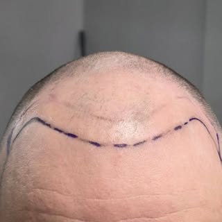 SCALP MICRO-PIGMENTATION  is a non invasive hair replacement procedure! 

This is the #1 fix for hai