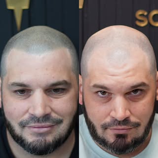 Natural. Undetectable. Life-changing. Another scalp micropigmentation transformation completed with 