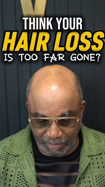 Hair loss can completely change the way you see yourself. But it doesn’t have to stay that way. 🔥

