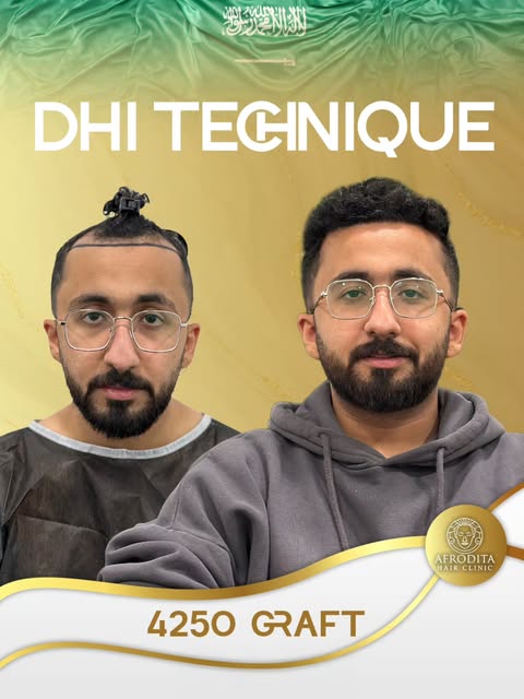 A magnificent transformation in just 8 months with the DHI Technique! 🌟

Witness the incredible 8th