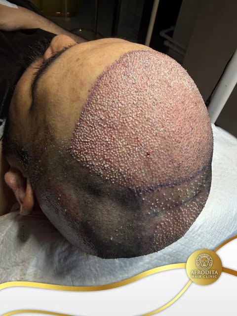At Afrodita Hair Clinic in Sisli, Istanbul, we set the benchmark for excellence with our highly skil