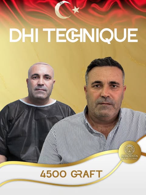 We are proud to share the magnificent and natural result achieved by our patient following a DHI hai