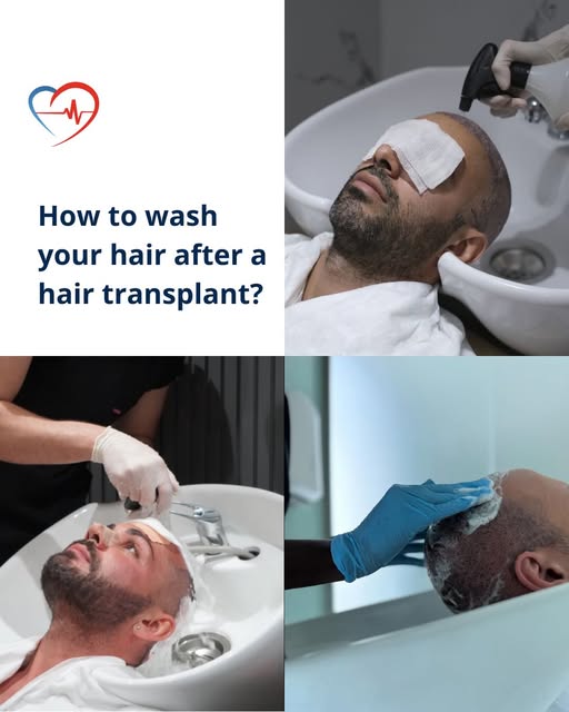 Proper aftercare is an essential part of a successful hair transplant.

Knowing when and how to wash