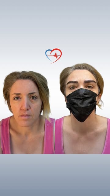 Eyebrow transplantation is a way to restore the natural density and shape of your brows.

Your own h