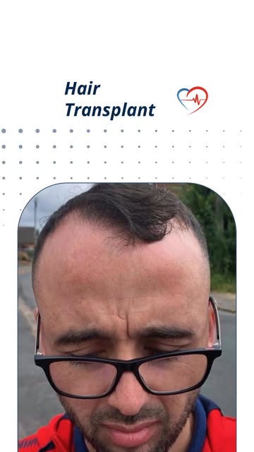 One FUE session, one transformative experience, and a permanent result that lasts a lifetime.

• 350