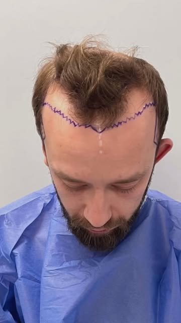 Give your hair a chance to glow!

• 3400 Grafts transplanted
• Technique: FUE
• Result: 12 Months 

