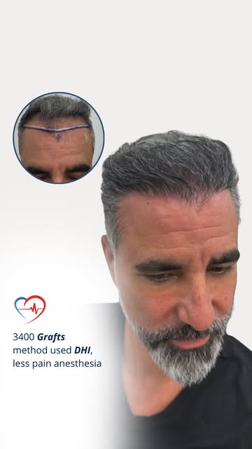 That perfect transformation you’ve been dreaming of😀

• 3400 Grafts transplanted
• Technique: DHI
•