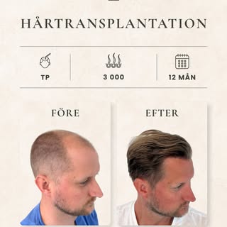 För ett år sedan valde Oscar att göra en hårtransplantation hos oss på ZARC. 

Idag är han nöjd med 