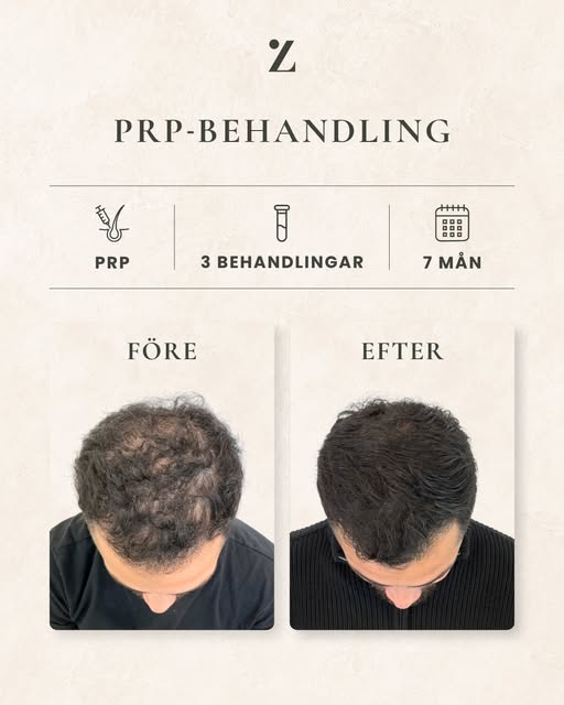 Rabah kom till ZARC Hair Clinic med inställningen att han behövde göra en hårtransplantation. Han ha