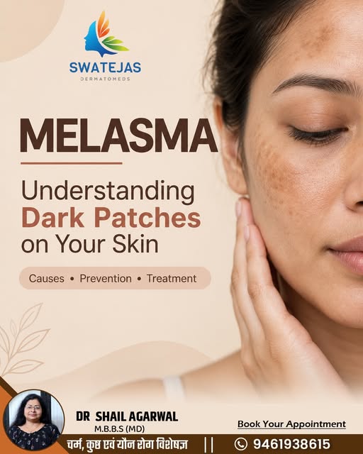 ✨ MELASMA: Understanding Dark Patches on Your Skin ✨

Melasma is a common skin condition that causes