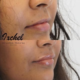 💉We are having a filler special for this month!! Buy now, use later!!💉