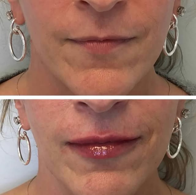 Sometimes it’s not about adding… it’s about restoring. 🤍

Over time, our lips naturally lose hydrat