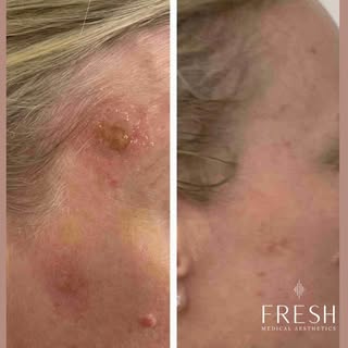 That brown spot you keep covering with makeup? There may be another option. ✨

This client came to u