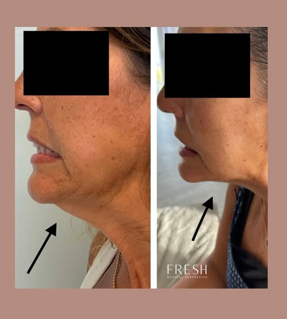 Not every Botox transformation happens on the forehead. 👀✨

If you’ve started noticing more pulling